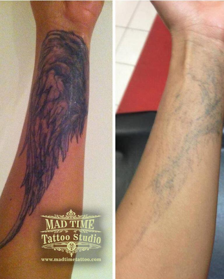 Experience safe and effective laser tattoo removal at Mad Time Tattoo in Liverpool. Our expert team uses advanced technology for optimal results!